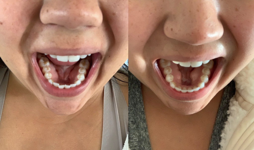 best clear aligners before and after candid co